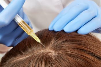 Le traitement de l’alopécie (chute des cheveux) à Liège