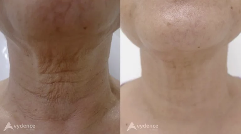 peeling_dual_mode-5