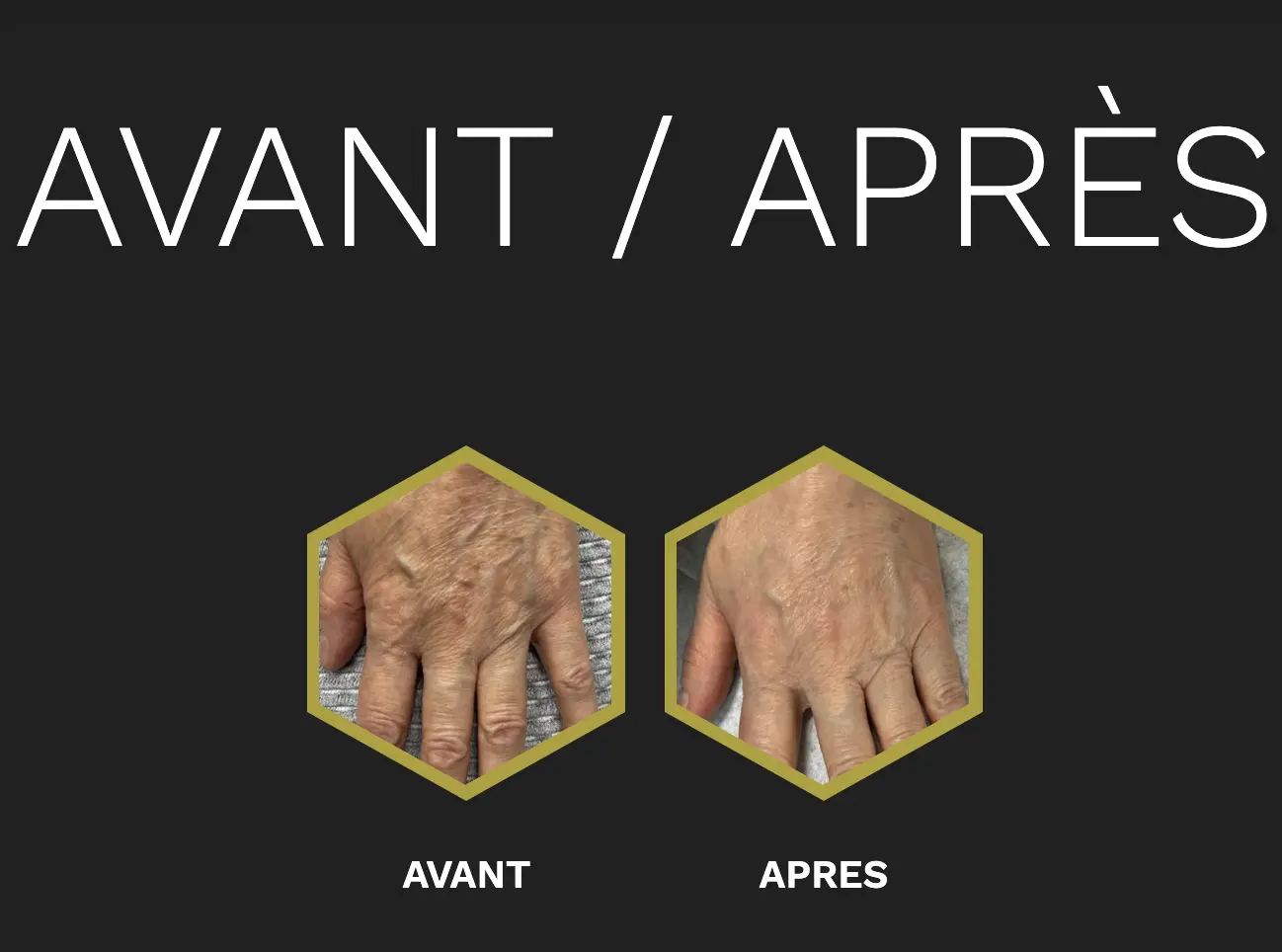 Résultat avant/après de l'utilisation du Karisma sur les mains