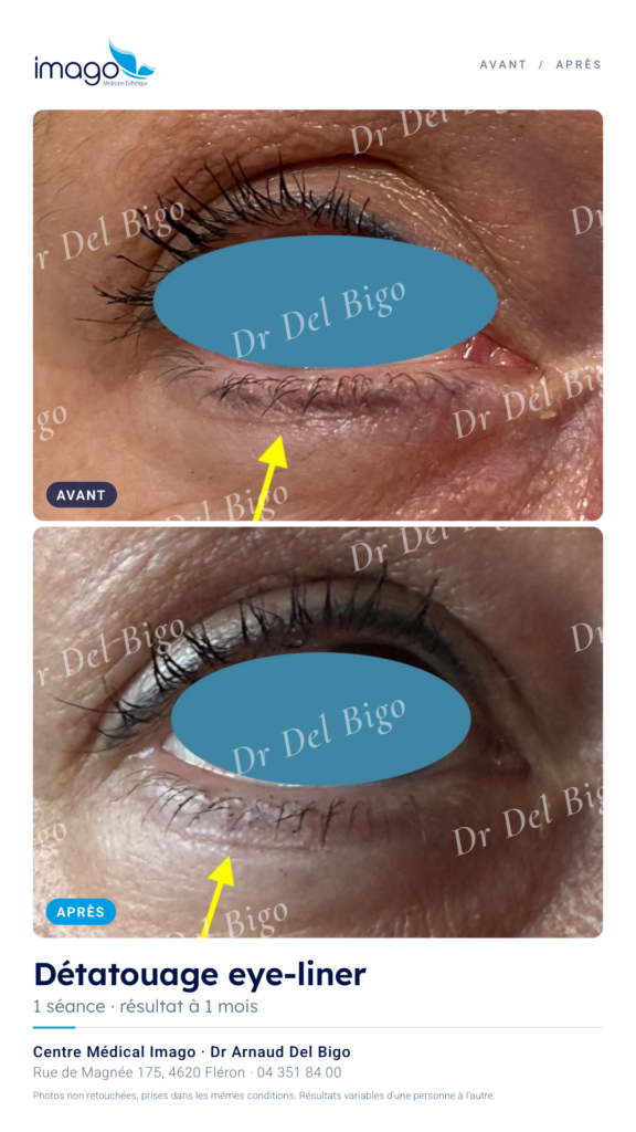 Détatouage maquillage 2
